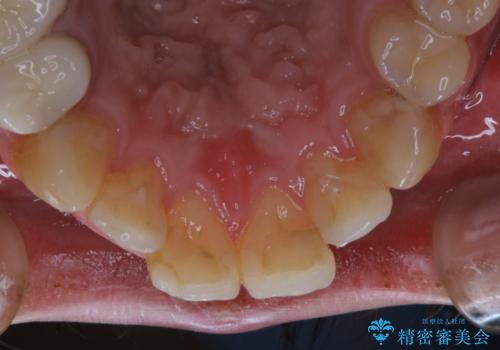 インビザライン矯正治療のスキャニング前のPMTCの治療前