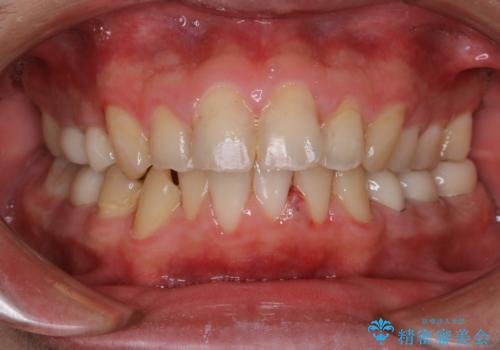 インビザライン矯正治療のスキャニング前のPMTCの治療後