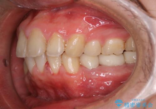 インビザライン矯正治療のスキャニング前のPMTCの治療後