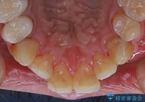 インビザライン矯正治療のスキャニング前のPMTCの治療後