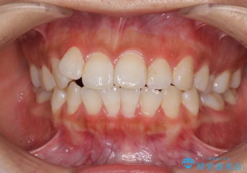 前歯のデコボコが気になる　インビザラインによる矯正治療の症例 治療前