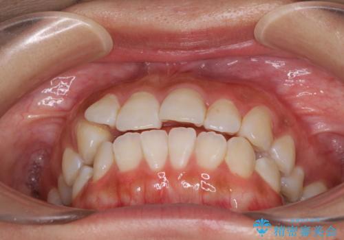 前歯のデコボコが気になる インビザラインによる矯正治療の治療前