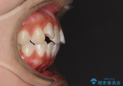 前歯のデコボコが気になる インビザラインによる矯正治療の治療前