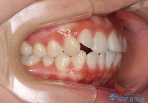 前歯のデコボコが気になる インビザラインによる矯正治療の治療前