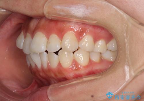 前歯のデコボコが気になる インビザラインによる矯正治療の治療前