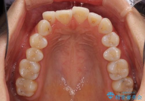 前歯のデコボコが気になる インビザラインによる矯正治療の治療前