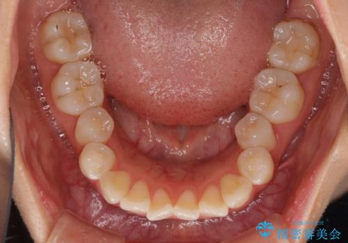 前歯のデコボコが気になる インビザラインによる矯正治療の治療前