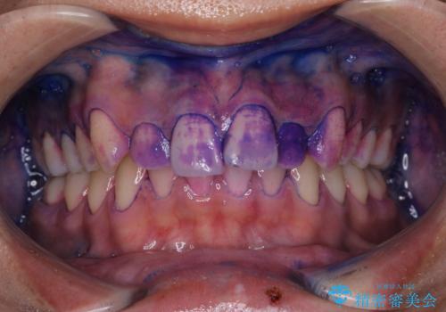 矯正治療を始める前に歯磨き指導とPMTCの治療前