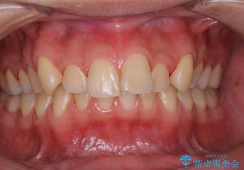 矯正治療を始める前に歯磨き指導とPMTCの治療後