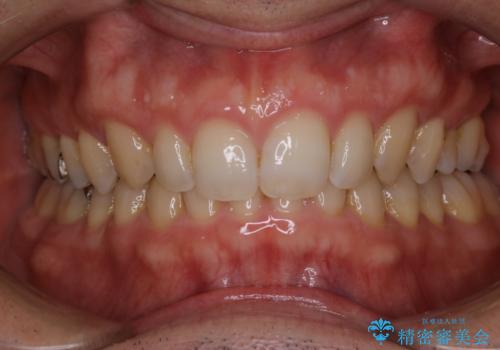 矯正治療終了後のメンテナンス PMTCで着色落としの治療前