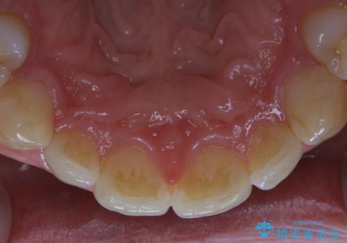 矯正治療終了後のメンテナンス PMTCで着色落としの治療前