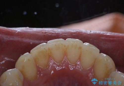 矯正治療終了後のメンテナンス PMTCで着色落としの治療前