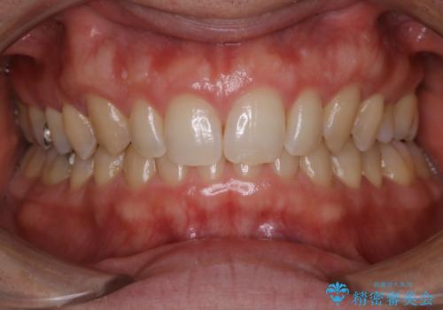 矯正治療終了後のメンテナンス PMTCで着色落としの治療後