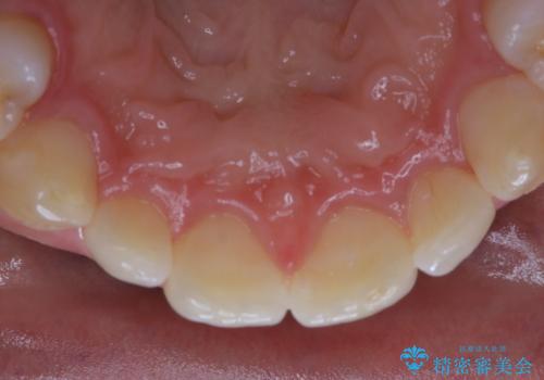 矯正治療終了後のメンテナンス PMTCで着色落としの治療後