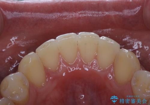 矯正治療終了後のメンテナンス PMTCで着色落としの治療後