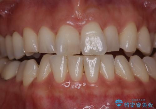 PMTCでツルツルの歯にの症例 治療前