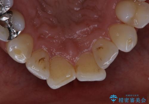 PMTCでツルツルの歯にの治療前