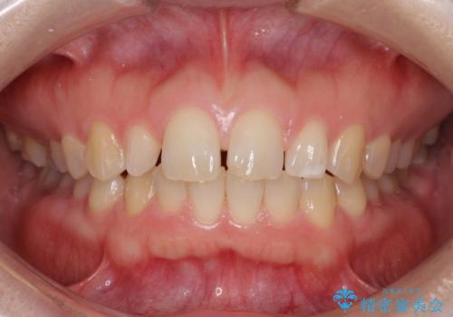前歯の歯並びと小さい歯を改善　インビザラインとオールセラミッククラウンの症例 治療前
