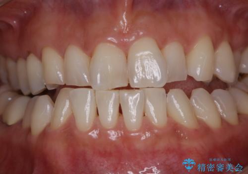 PMTCでツルツルの歯にの症例 治療後