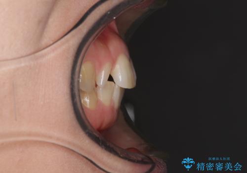 前歯の歯並びと小さい歯を改善 インビザラインとオールセラミッククラウンの治療前