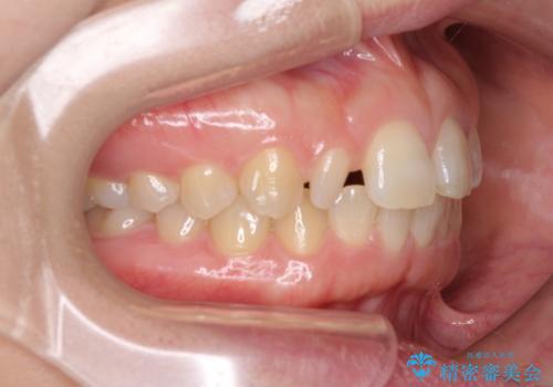 前歯の歯並びと小さい歯を改善 インビザラインとオールセラミッククラウンの治療前