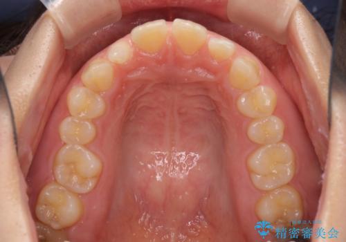 前歯の歯並びと小さい歯を改善 インビザラインとオールセラミッククラウンの治療前