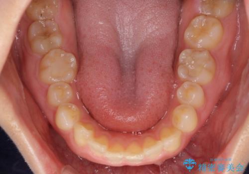 前歯の歯並びと小さい歯を改善 インビザラインとオールセラミッククラウンの治療前