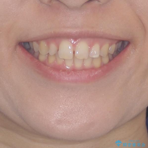 前歯の歯並びと小さい歯を改善　インビザラインとオールセラミッククラウンの治療前（顔貌）