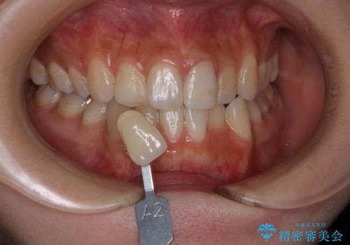 オフィスホワイトニング エクセレントの治療前