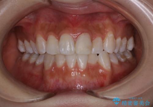 オフィスホワイトニング エクセレントの症例 治療後
