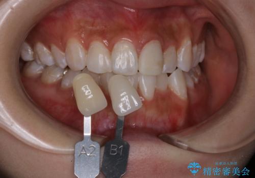 オフィスホワイトニング エクセレントの治療後