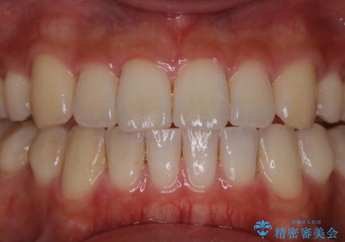 PMTCで3カ月に1度のメンテナンスの治療前