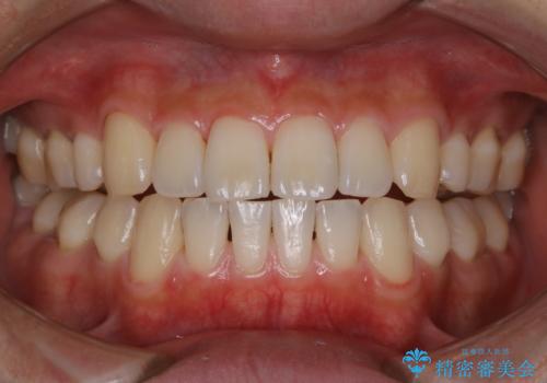 PMTCで3カ月に1度のメンテナンスの治療後