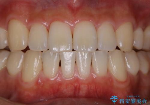 PMTCで3カ月に1度のメンテナンスの治療後