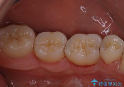 PMTCで3カ月に1度のメンテナンスの症例 治療後
