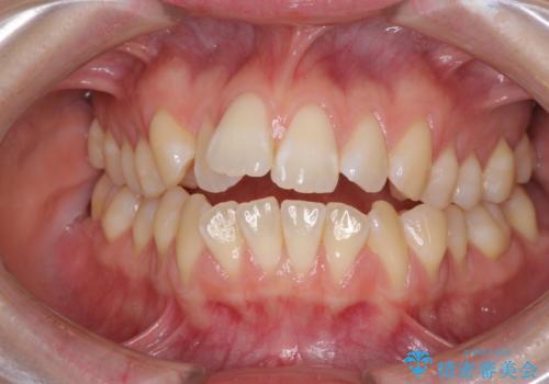 気になるデコボコとオープンバイト インビザラインでの矯正治療の症例 治療前
