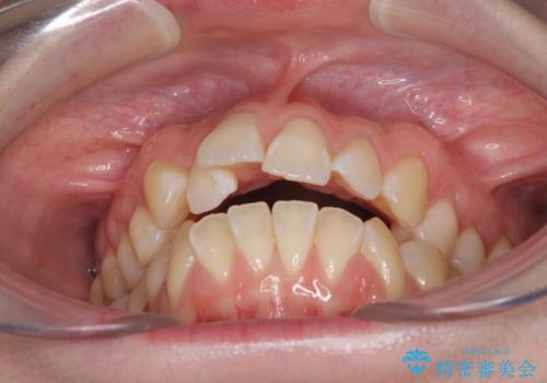 気になるデコボコとオープンバイト インビザラインでの矯正治療の治療前