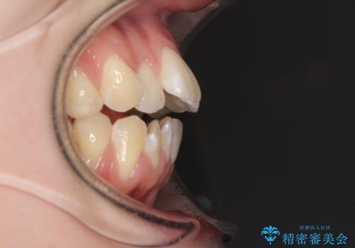 気になるデコボコとオープンバイト インビザラインでの矯正治療の治療前