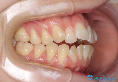 気になるデコボコとオープンバイト インビザラインでの矯正治療の治療前