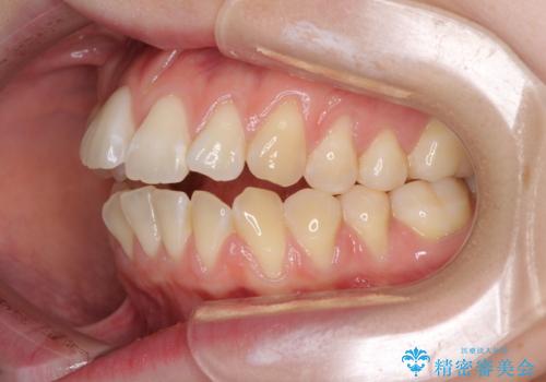 気になるデコボコとオープンバイト インビザラインでの矯正治療の治療前