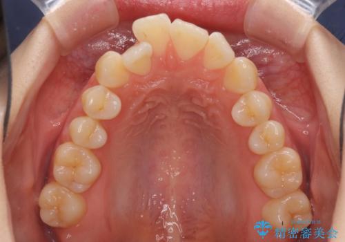 気になるデコボコとオープンバイト インビザラインでの矯正治療の治療前