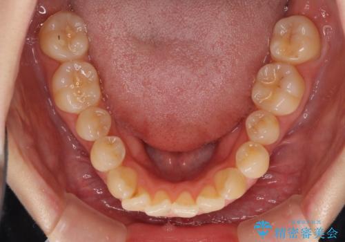 気になるデコボコとオープンバイト インビザラインでの矯正治療の治療前