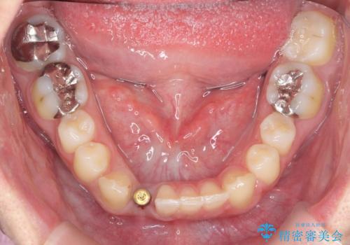 下の前歯のインプラント　生まれつき歯が少ないの治療中