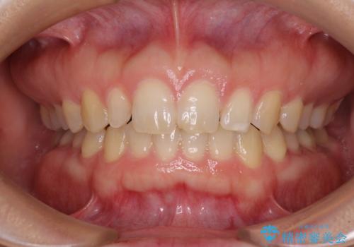 前歯の歯並びと小さい歯を改善 インビザラインとオールセラミッククラウンの治療中