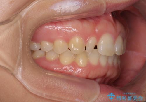 前歯の歯並びと小さい歯を改善　インビザラインとオールセラミッククラウンの治療中