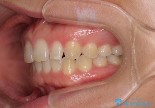 前歯の歯並びと小さい歯を改善 インビザラインとオールセラミッククラウンの治療中