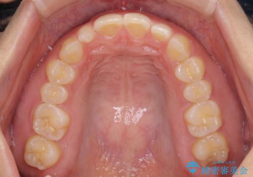 前歯の歯並びと小さい歯を改善 インビザラインとオールセラミッククラウンの治療中