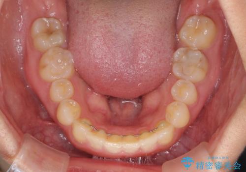 前歯の歯並びと小さい歯を改善 インビザラインとオールセラミッククラウンの治療中