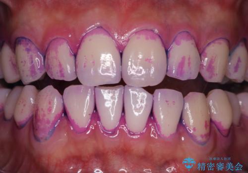 日々の磨き残しをPMTCできれいにの治療前