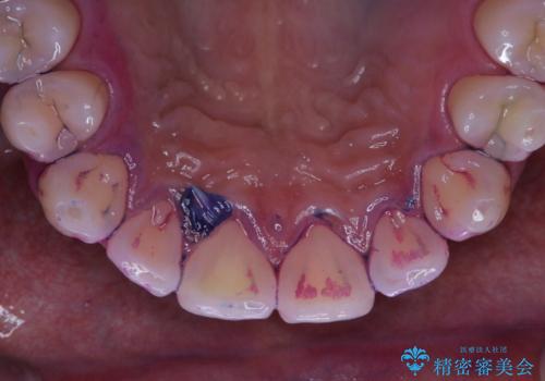 日々の磨き残しをPMTCできれいにの治療前